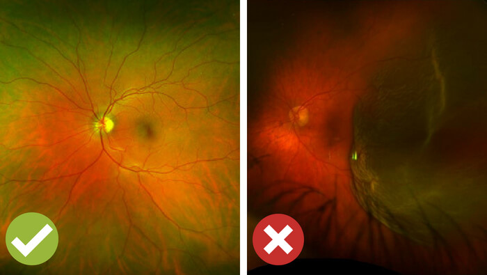 Optos Optomap ultra-widefield retinal imaging